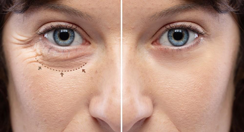 Eyelid Surgery 