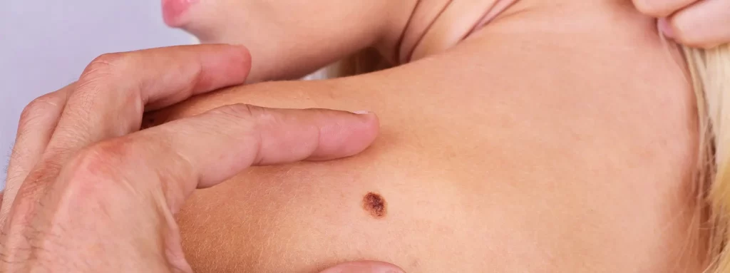 Skin Cancer